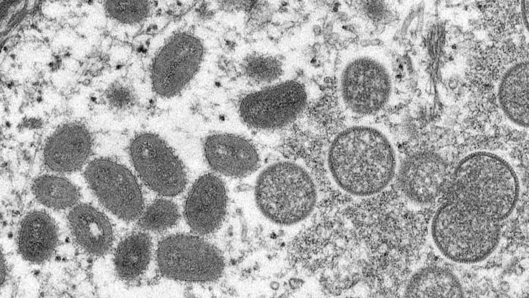 Monkeypox raises concern amid Corona, alert issued at Mumbai airport