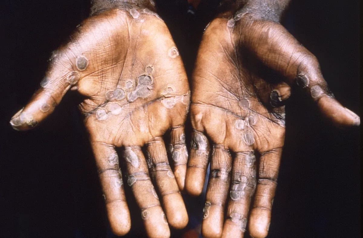 Delhi man tests positive for Monkeypox – no foreign travel history found
